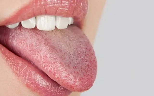 رنگ زبان شما چه هشداری درباره سلامت بدنتان می‌دهد؟